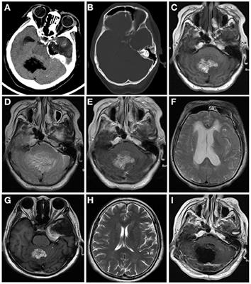 Radiological and Clinical Findings of Multiple Cerebellar Liponeurocytoma: A Case Report